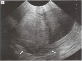 Polipi, cancer endometrial - uter și anexe