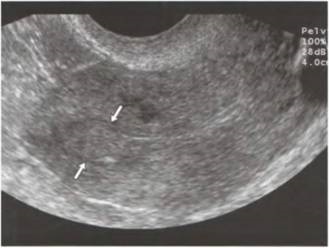 Polipi, cancer endometrial - uter și anexe