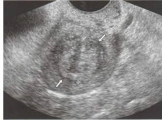 Polipi, cancer endometrial - uter și anexe