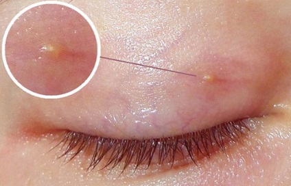 Pimple pe pleoape sub cauzele genelor și tratamentul