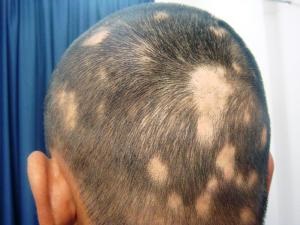 Tratamentul alopeciei în casă