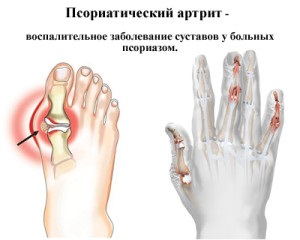 Artrita psoriazică - simptome și fotografii