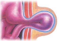 Herniile ombilicale după naștere cauze, simptome, tratament