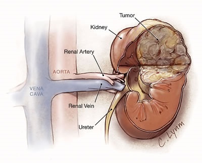 Cancerul de rinichi, tratamentul remediilor folclorice ale cancerului de rinichi