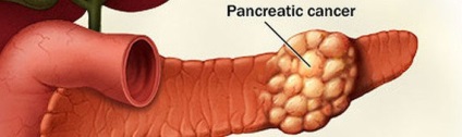 Cancerul pancreasului