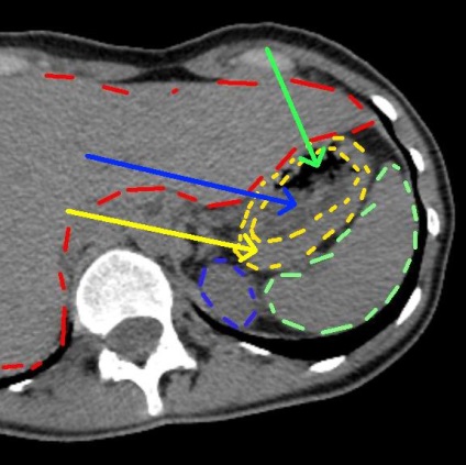 Decodarea cancerului pulmonar, 1 răspuns, 38 de comentarii, forumul de consultare 