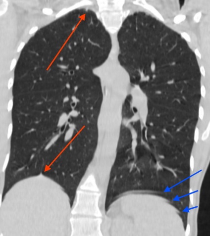 Decodarea cancerului pulmonar, 1 răspuns, 38 de comentarii, forumul de consultare 