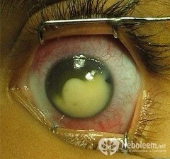 Retinoblastomul la copii - tratament, diagnostic, cauze