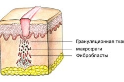 Cicatrici după operație și tratamentul acestora