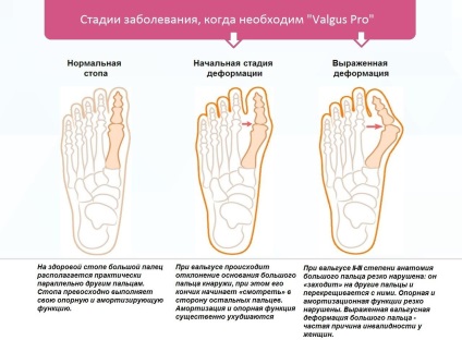 A lábakon lévő kúpok és a kezelés a módja annak, hogy megszabaduljanak