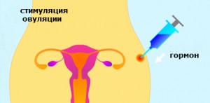 Sindromul de hiperstimulare ovariană - sănătatea și stilul de viață al femeilor