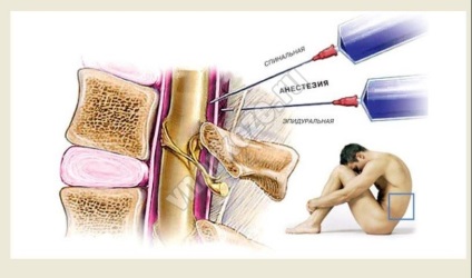 Diferențele anesteziei spinale și epidurale