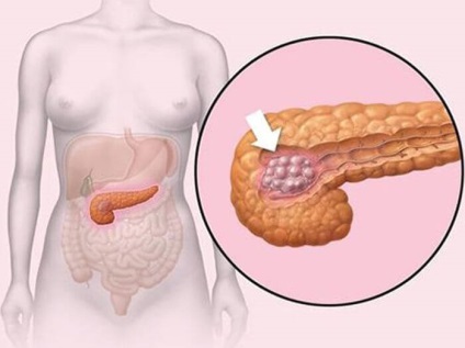 Steatoza cauzelor pancreasului, simptome, tratament
