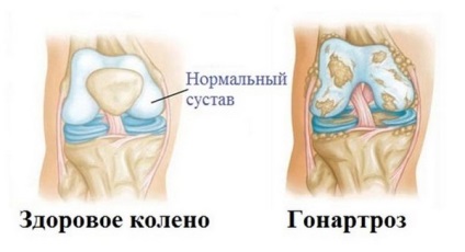 Степента на остеоартрит на симптомите на коляното и характеристиките на лечението