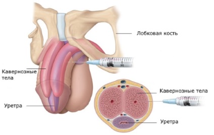 Îndepărtarea oleogranulomului penisului