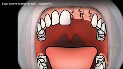 Hogyan távolítsuk el a fogakat, hogyan toleráljuk a fogfájást