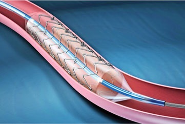 Instalarea stenturilor vaselor coronare și arterelor