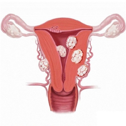 Nodal uterin miom