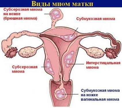 Nodal uterin miom