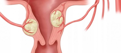 Nodal uterin miom