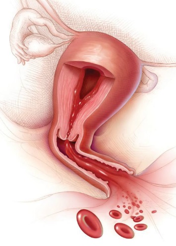 Alocări pentru cancerul de col uterin, cancer - tratament și prevenire