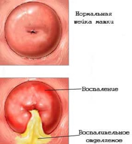 Alocări pentru cancerul de col uterin, cancer - tratament și prevenire