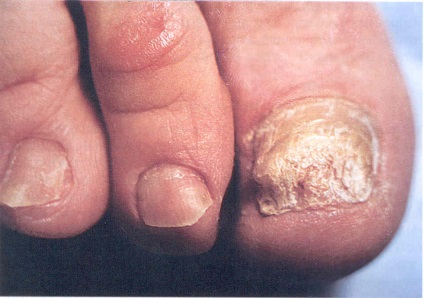 Tipuri de boli fungice ale unghiilor și tratamentul lor, doar frumusețea mea