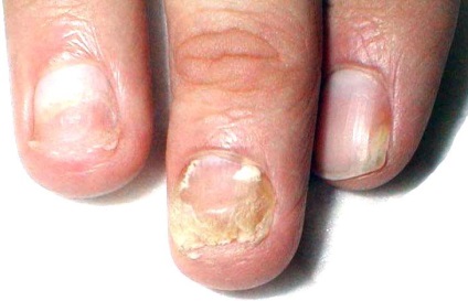 Tipuri de boli fungice ale unghiilor și tratamentul lor, doar frumusețea mea