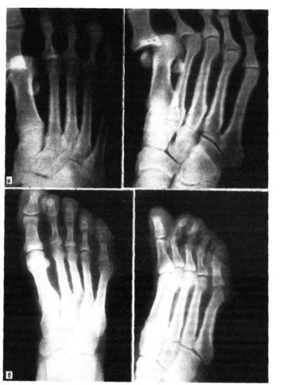 Dislocarea falangelor degetelor de la picioare