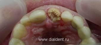 Restaurarea dinților cu un nerv îndepărtat, coroana la dinte, inserția dentară, îndepărtarea nervului din dinți