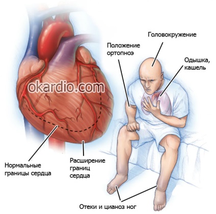 Toate simptomele și semnele insuficienței cardiace la bărbați