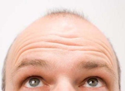 Androgenic și androgenetic alopecie