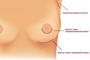 Mamoplastie de augmentare