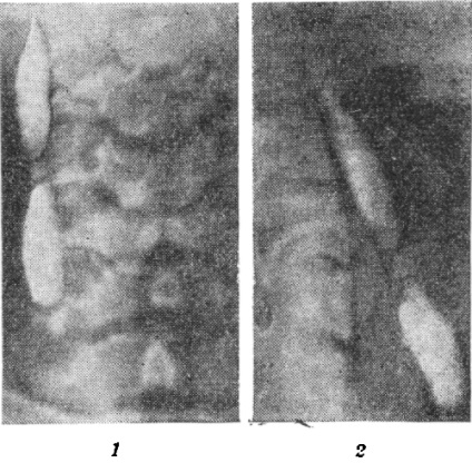 Chist brancheogenic 1