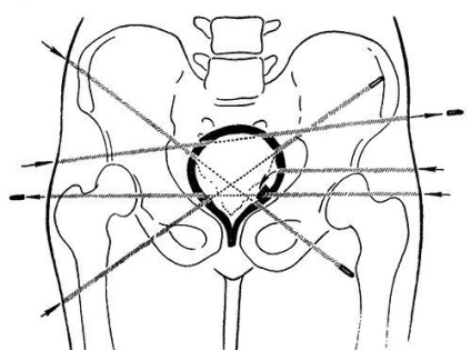 Simptomele și diagnosticarea leziunilor pelvine și pelvine