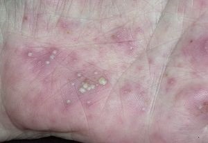 Disgiodoroza (eczemă dishidrotică)