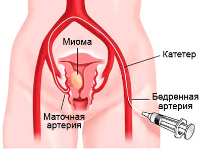 Embolizarea arterelor uterine - clinica universității medicale