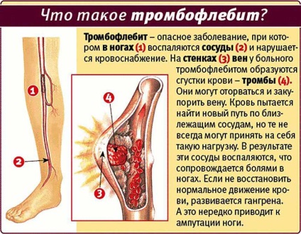 Fotografie a tromboflebitei venelor inferioare - simptome, cauze de dezvoltare