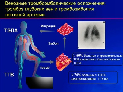 Fotografie a tromboflebitei venelor inferioare - simptome, cauze de dezvoltare