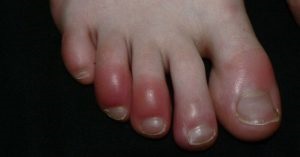 Picioarele gangrene cu simptome de diabet, predicții, tratament