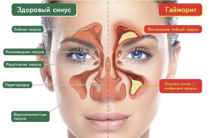 Tratamentul sinuzitelor și simptomele