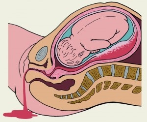 Hematoma a méhben terhesség alatt, császármetszés után