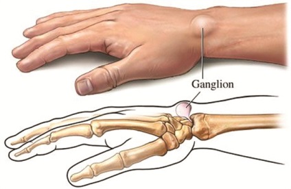 Hygroma - simptome, cauze, tratament și diagnostic