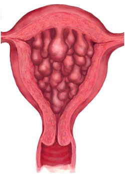 Hiperplazia endometrială