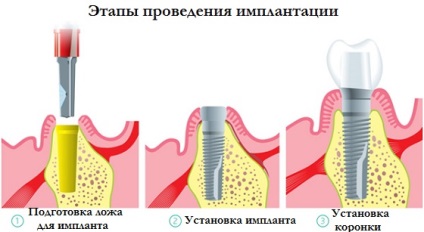 Implantologie în stomatologie - centrele de implantologie dentară din Moscova, Sankt-Petersburg și cele inferioare