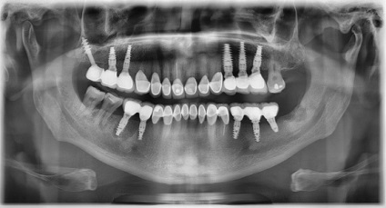 Implantologie în stomatologie - centrele de implantologie dentară din Moscova, Sankt-Petersburg și cele inferioare