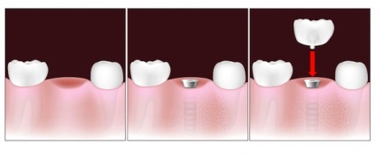 Implantologie în stomatologie - centrele de implantologie dentară din Moscova, Sankt-Petersburg și cele inferioare