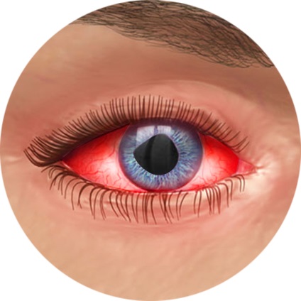 Iridocyclitis (anterior uveitis), tünetek, okok, típusok, kezelés