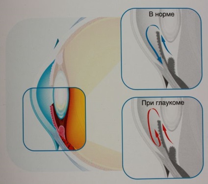 Cum apare glaucomul și se manifestă