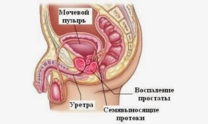 Ename cu beneficii de prostatită, rețete, restricții